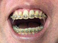 ゴムをふたたびかける