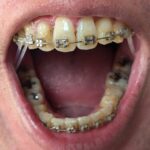 2025年10月23日の歯の矯正の報告