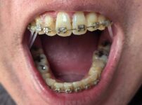 2025年10月23日の歯の矯正の報告