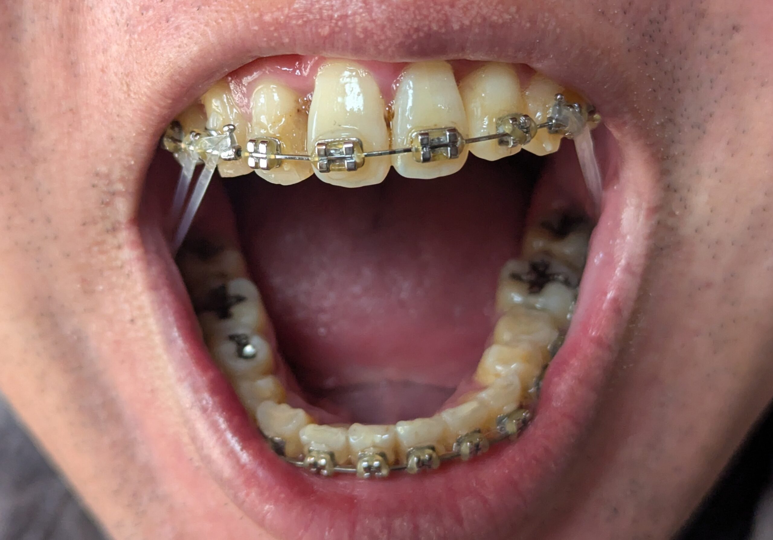 2025年10月23日の歯の矯正の報告