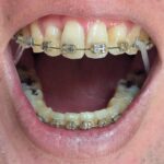 2025年11月17日の歯の矯正の様子