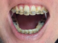 2025年11月17日の歯の矯正の様子