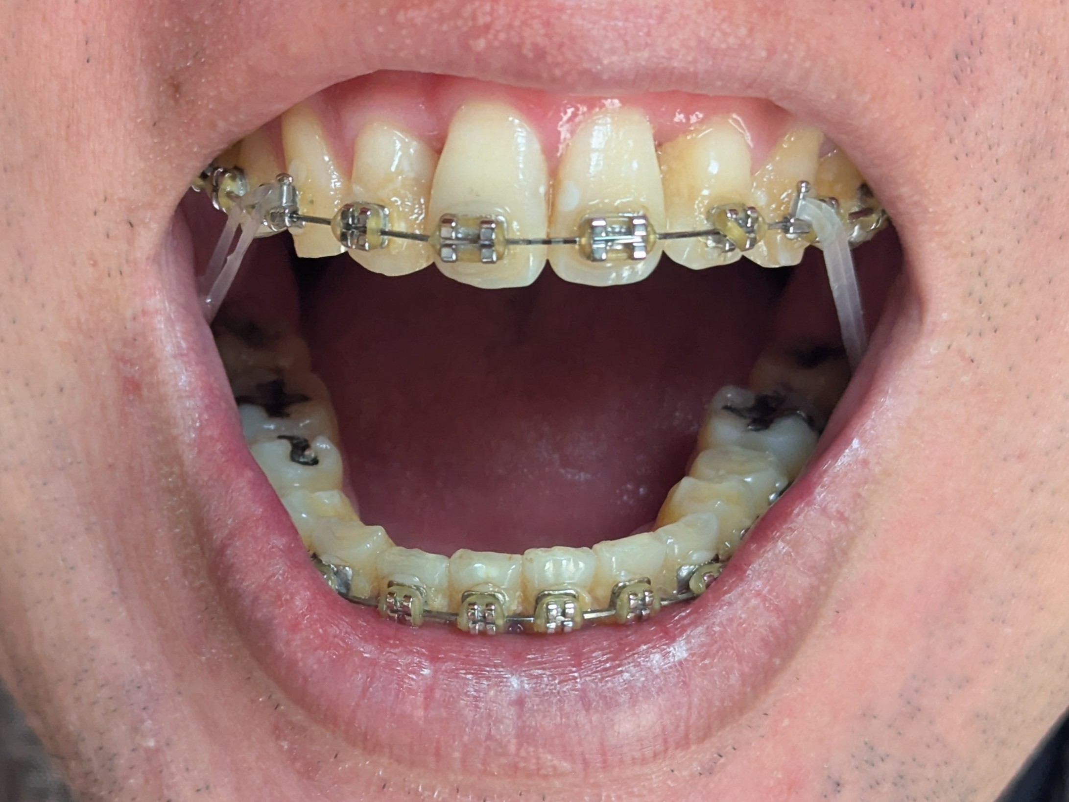 2025年11月17日の歯の矯正の様子