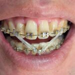 20251222日の歯の様子