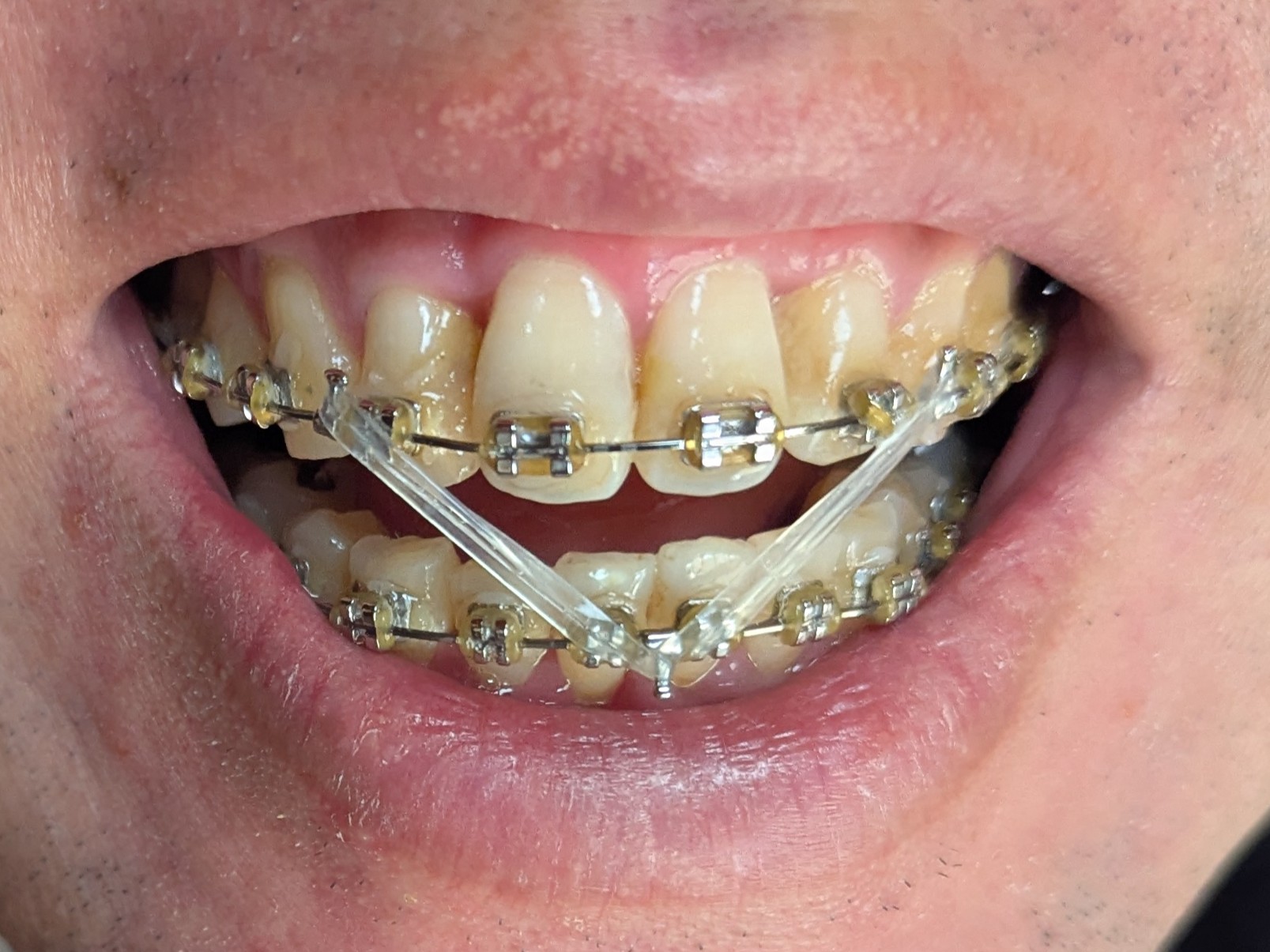 20251222日の歯の様子