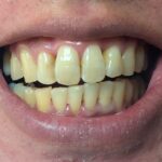 歯の矯正終了まじか