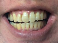 歯の矯正終了まじか