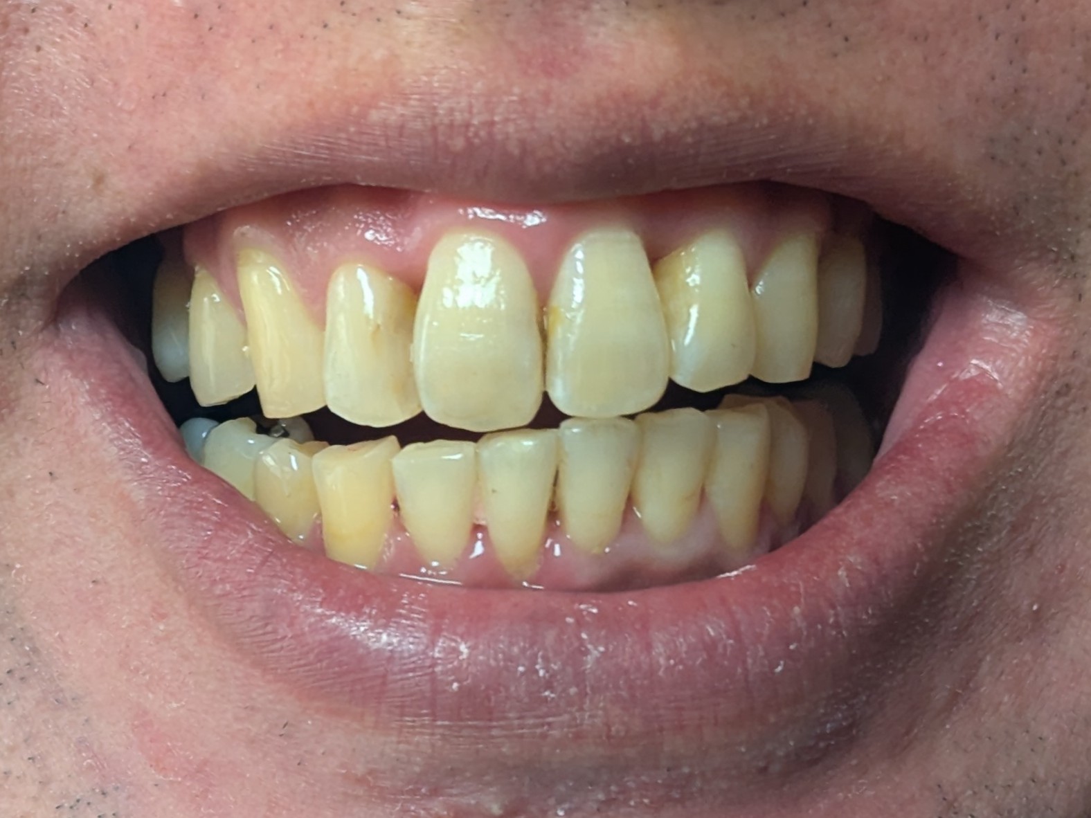 歯の矯正終了まじか